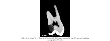 Micro-CT scan of an extracted tooth that was endodontically treated